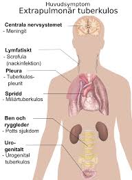  Tuberculosis